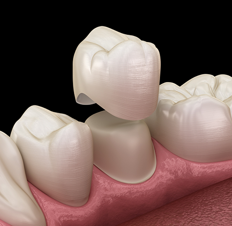 Illustration of dental crown being placed on tooth